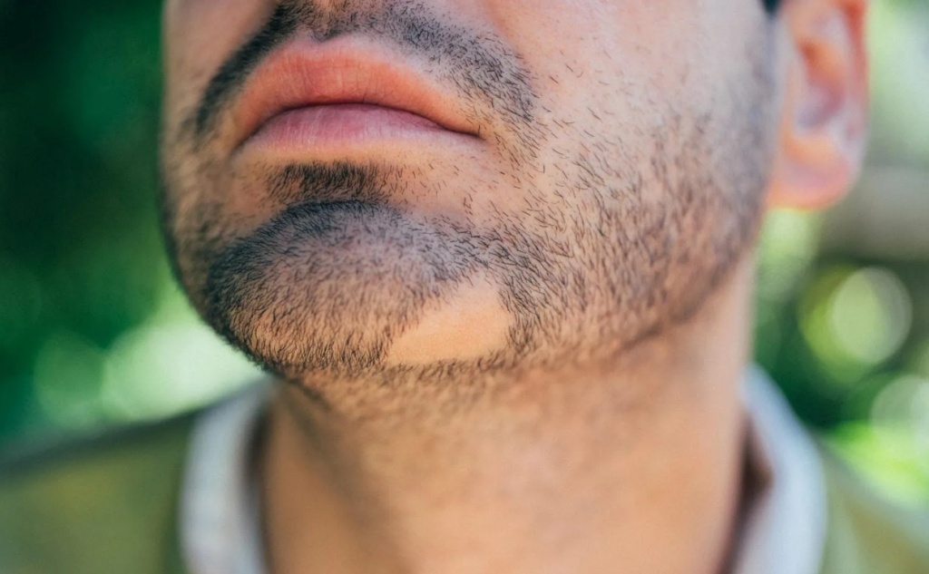 Алопеция бороды (проплешины) у мужчин